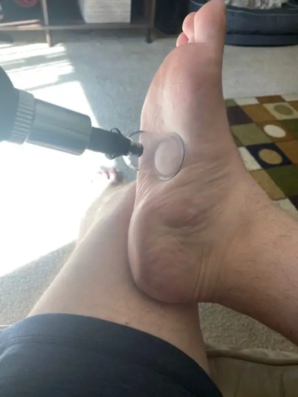cupping placement plantar fasciitis