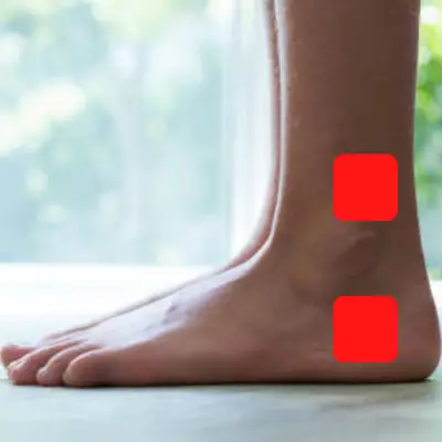 tens placement plantar fasciitis